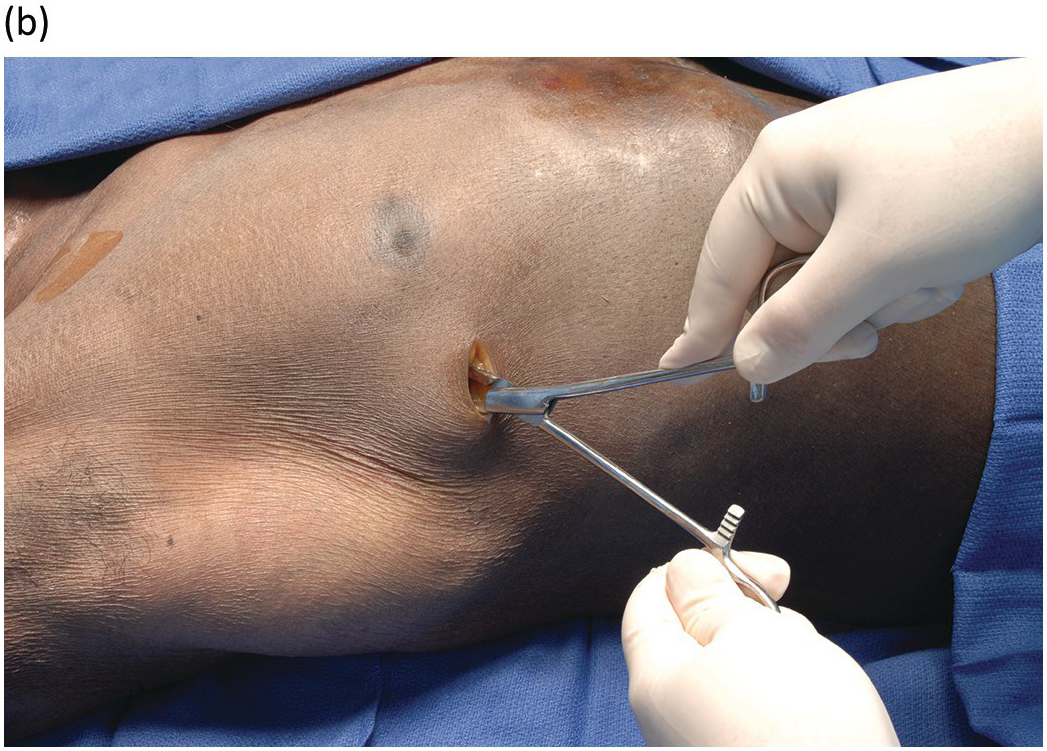 chest tube insertion