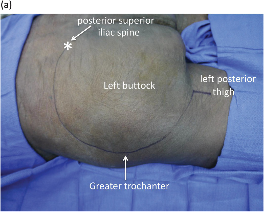 Lower Extremity Fasciotomies (Chapter 44) - Atlas of Surgical