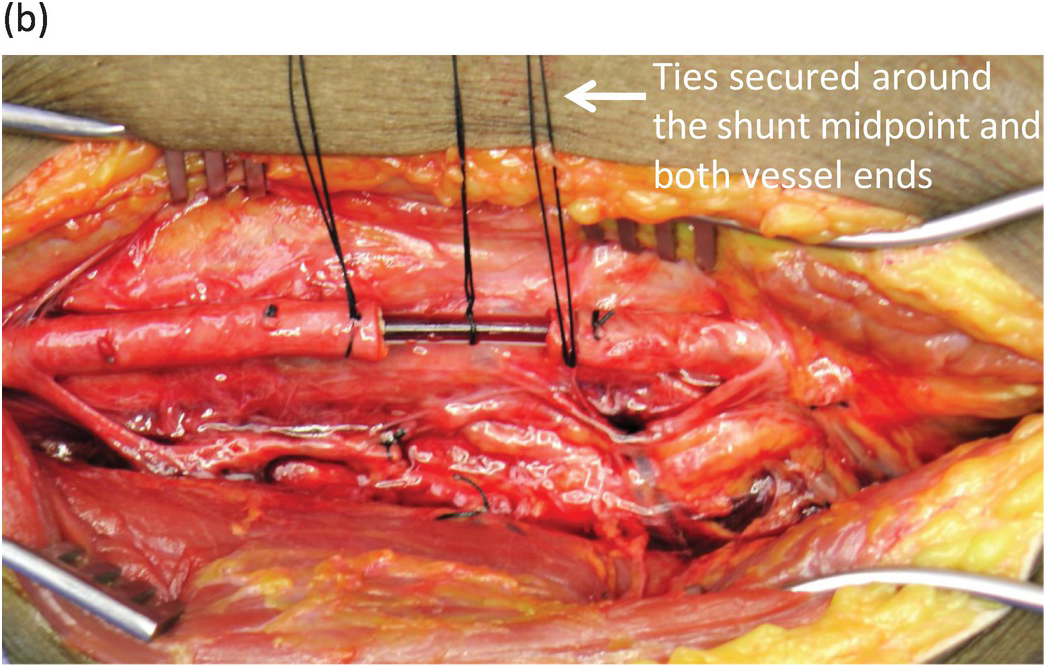 Temporary Vascular Shunts (Chapter 49) - Atlas of Surgical Techniques in  Trauma