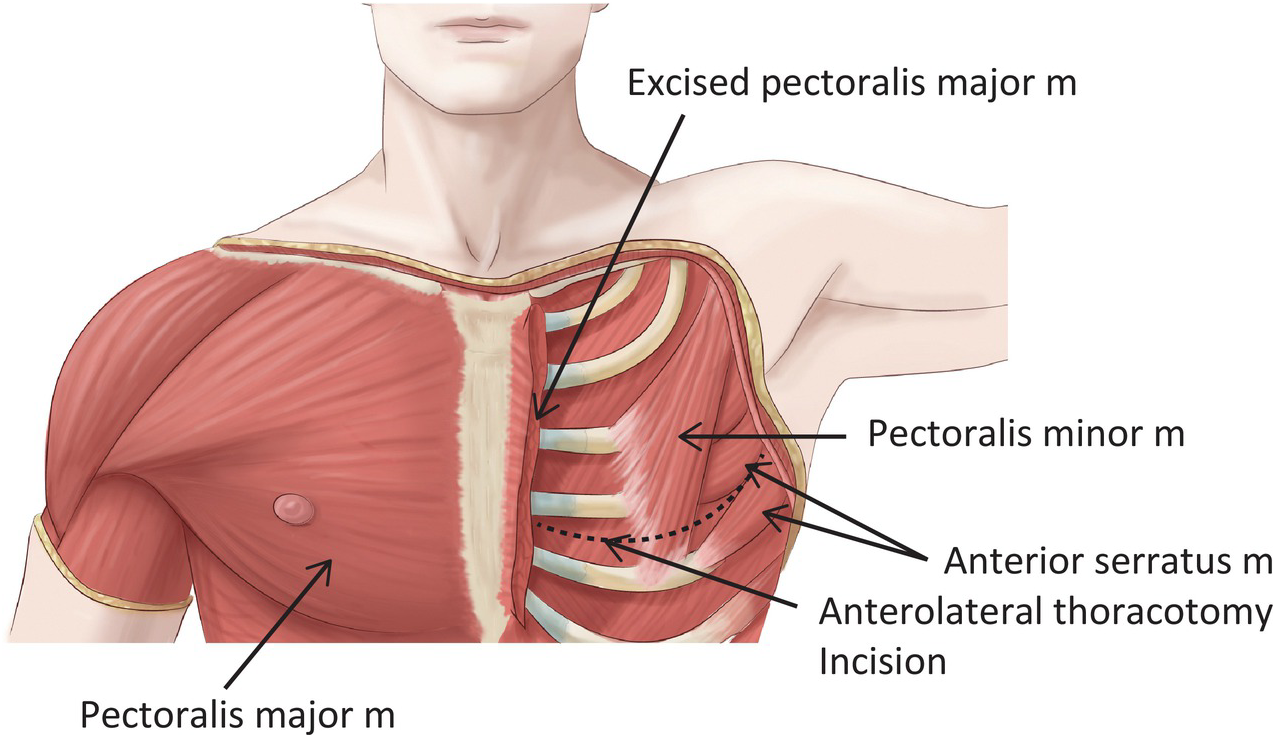 Emergency Room Resuscitative Thoracotomy Chapter 4 Atlas of