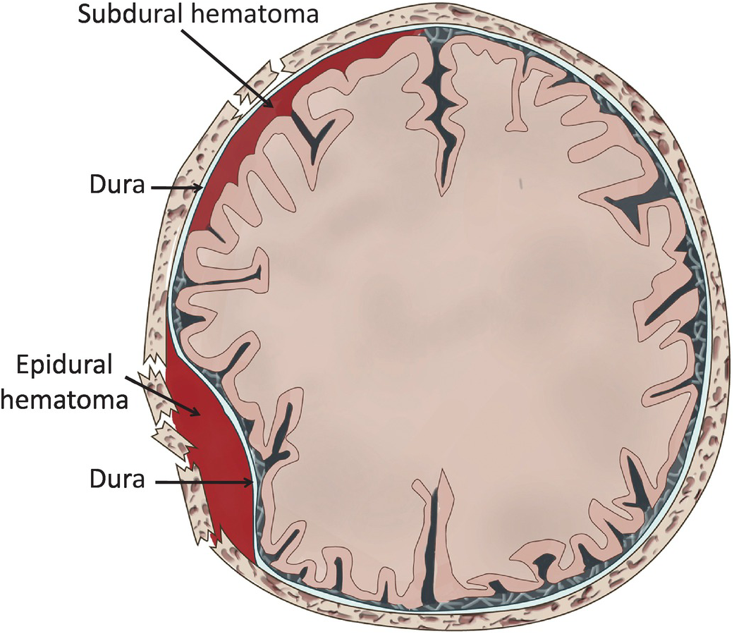 Epidural Hematoma Vs Subdural Hematoma