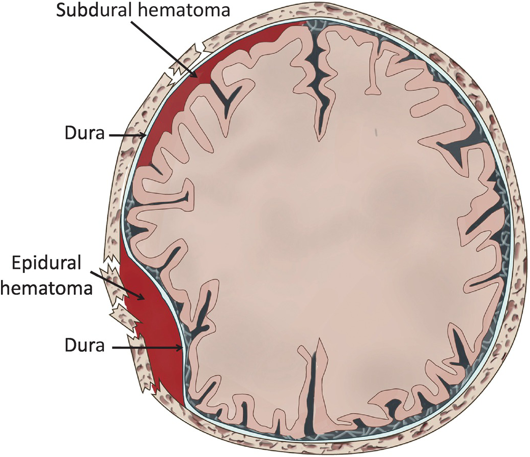 Hematoma subdural hematoma vs epidural Subdural And