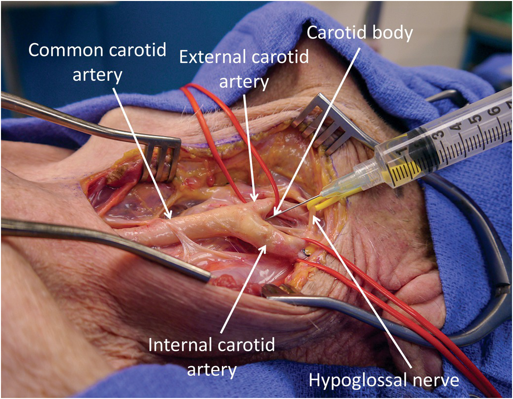 jugular vein and carotid artery