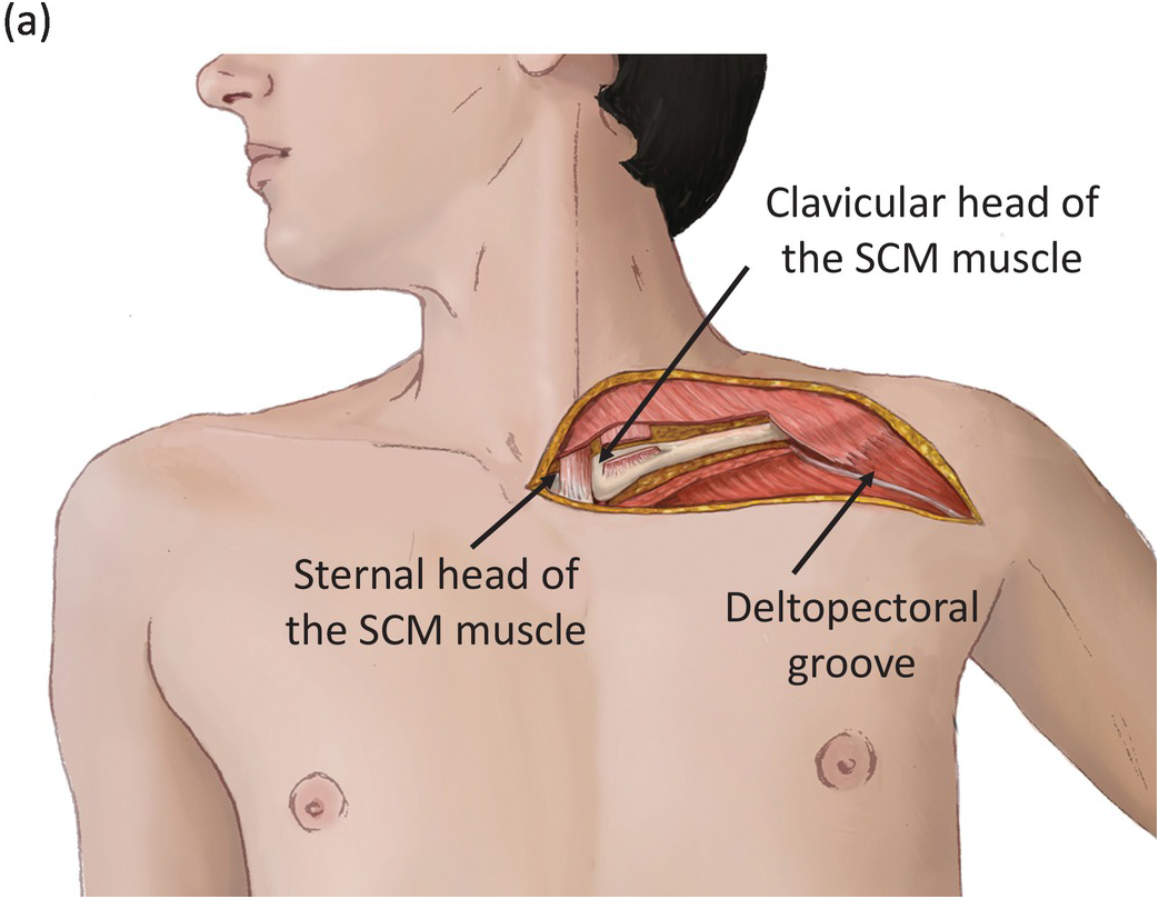 subclavian vein axillary vein