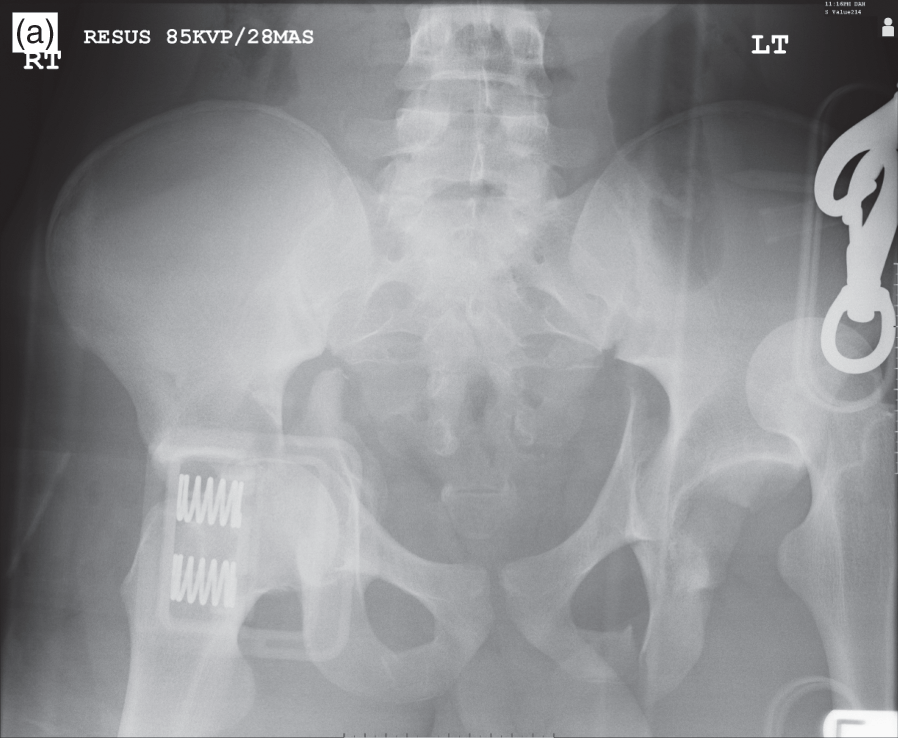 What are open book pelvic fractures?