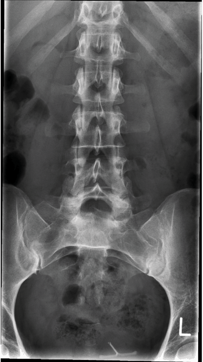 X ray dorso lumbar spine A/P and lateral views showing Kypho-scoliosis