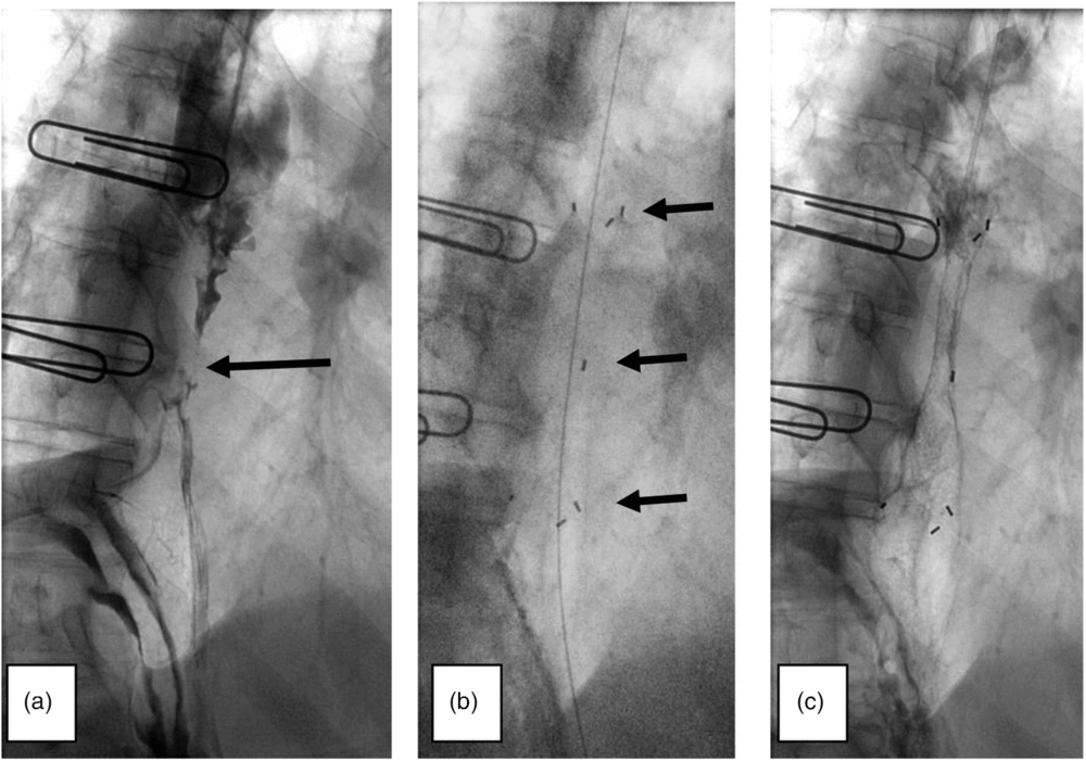 Biodegradable oesophageal stents: A potentially useful adjunct in the ...