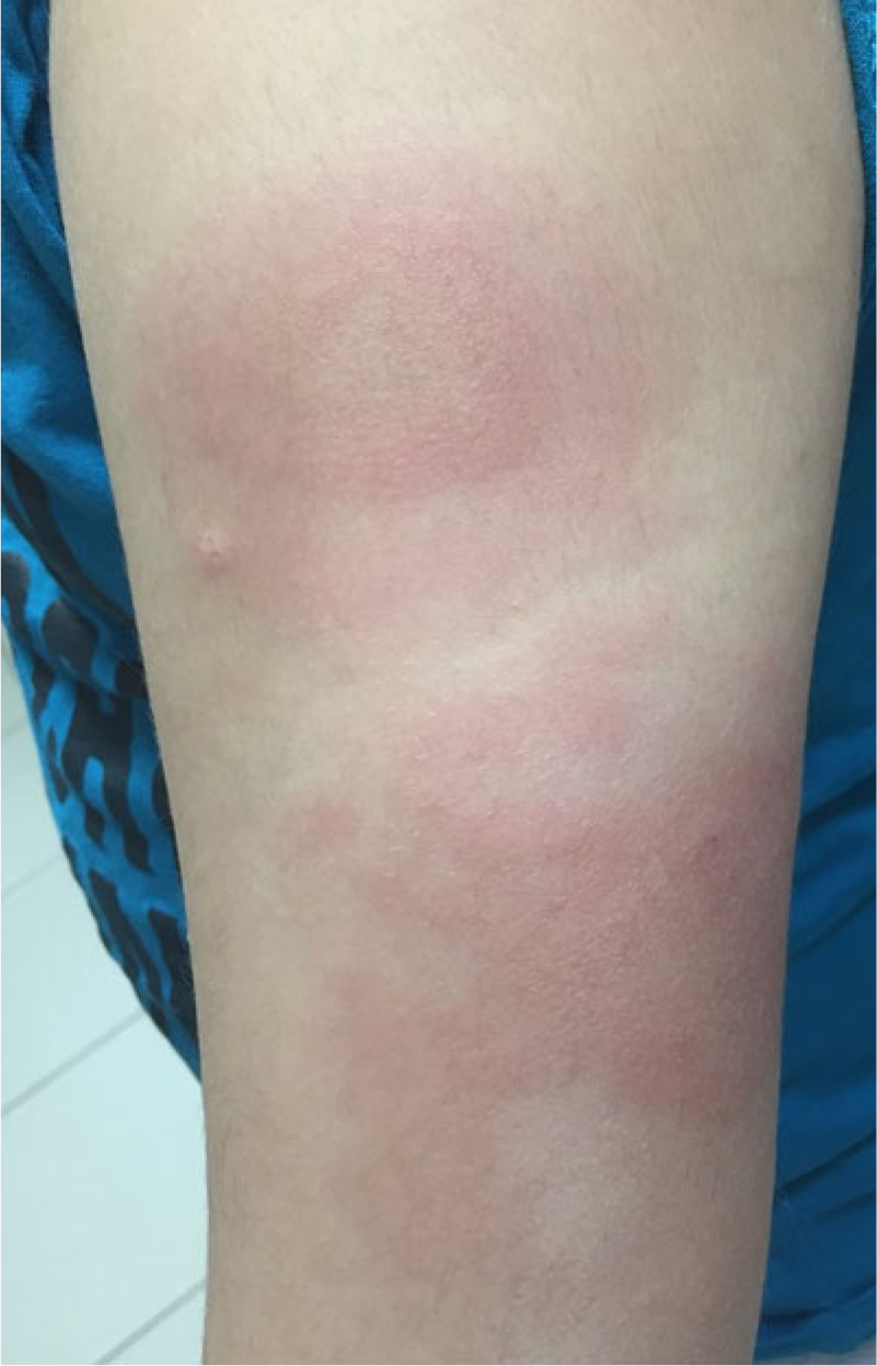 Anakinra Rash Anaphylactic reaction to anakinra in a child with steroid-dependent ...