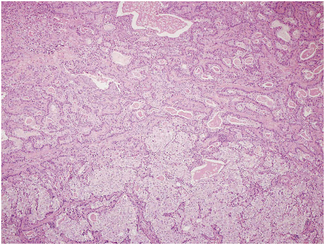 Pleomorphic adenoma parotid pathology outlines
