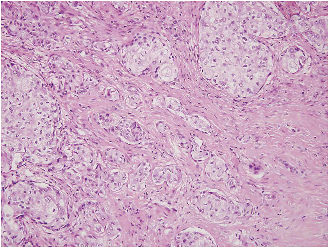 pleomorphic adenoma pathology