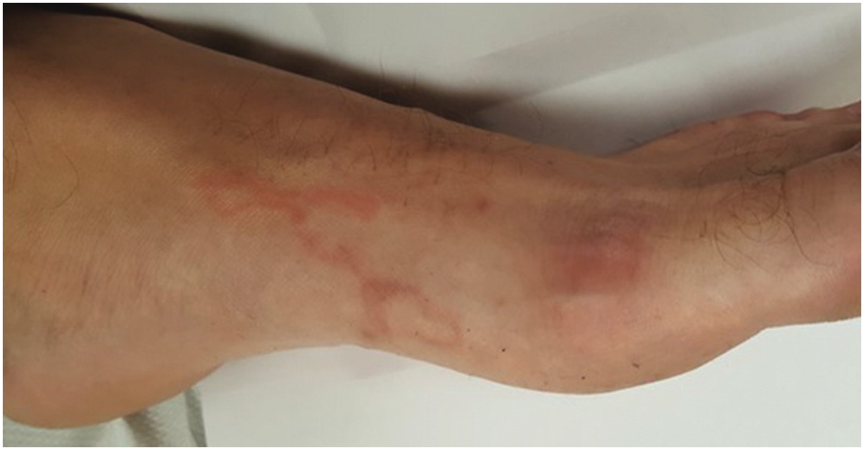 hidradenitis suppurativa 1177