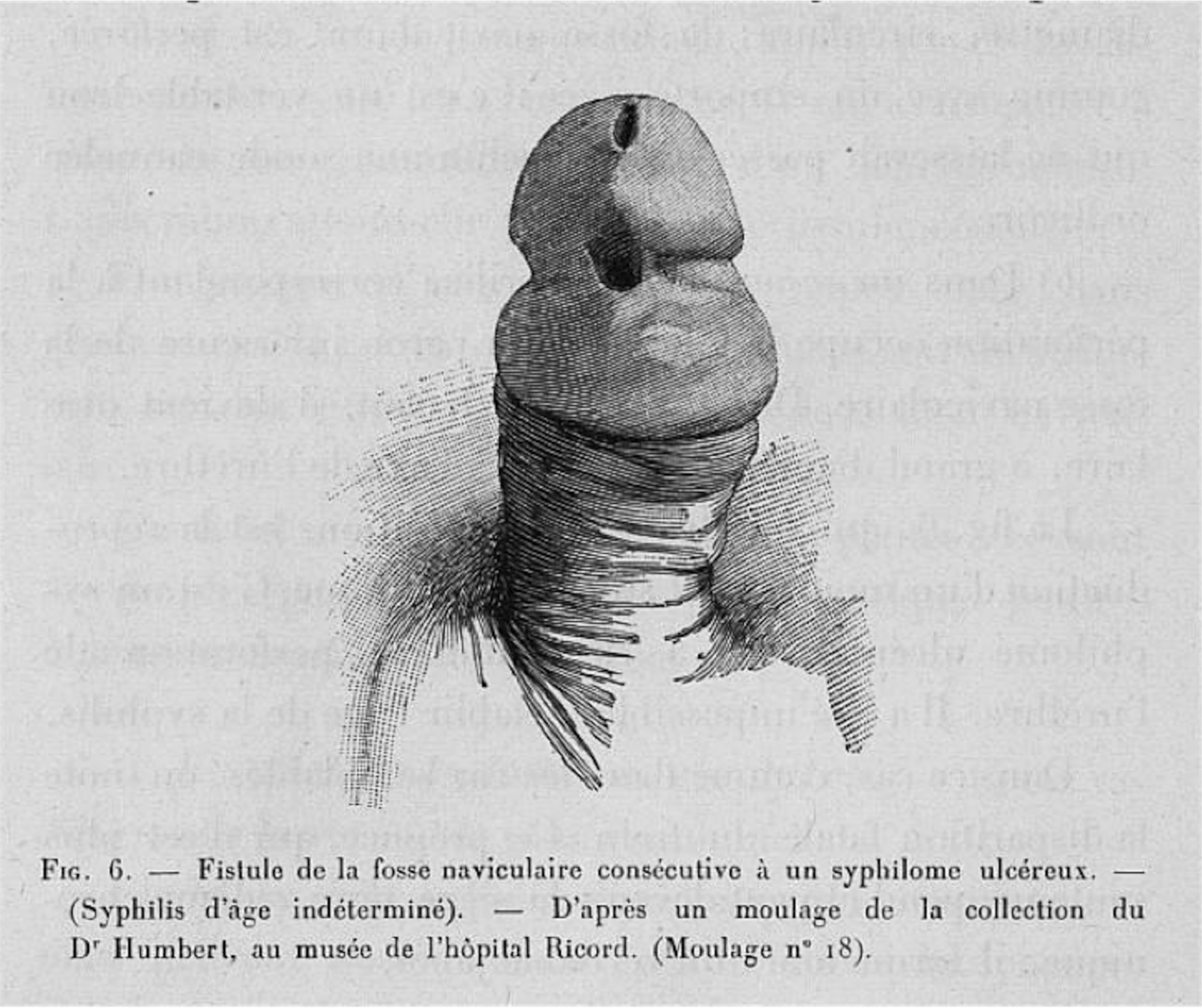 Photograph as Skin, Skin as Wax: Indexicality and the Visualisation of  Syphilis in Fin-de-Siècle France The William Bynum Prize Essay | Medical  History | Cambridge Core