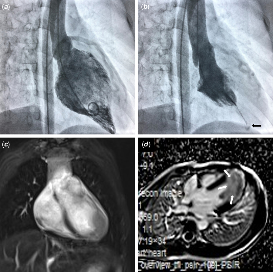 Apical hypertrophic cardiomyopathy an cause of exertional