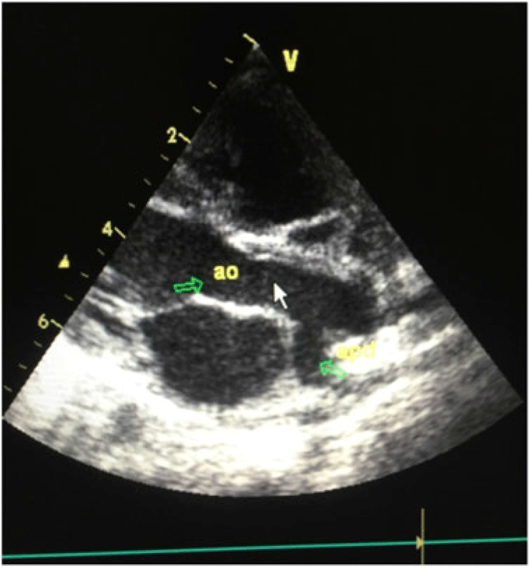 Anomalous origin of left pulmonary artery from the ascending aorta ...