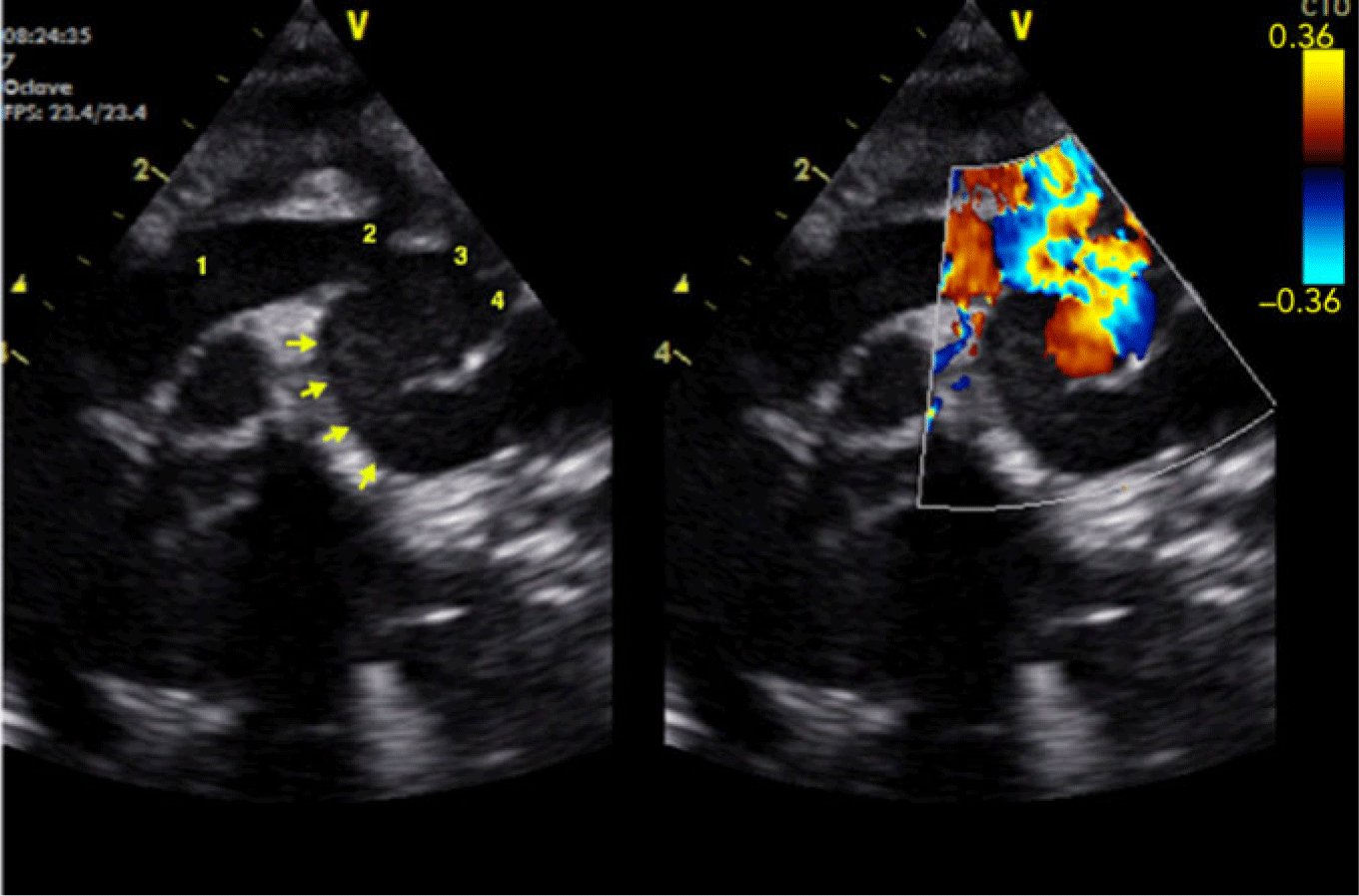 Pseudoaneurysm of the aortic arch early after coarctation repair in the ...