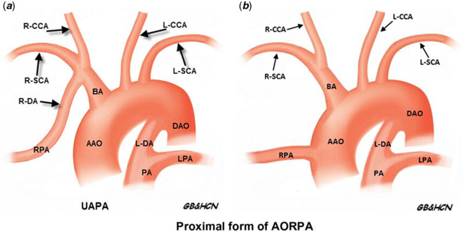 Prenatal diagnosis of anomalous origin of one pulmonary artery branch ...