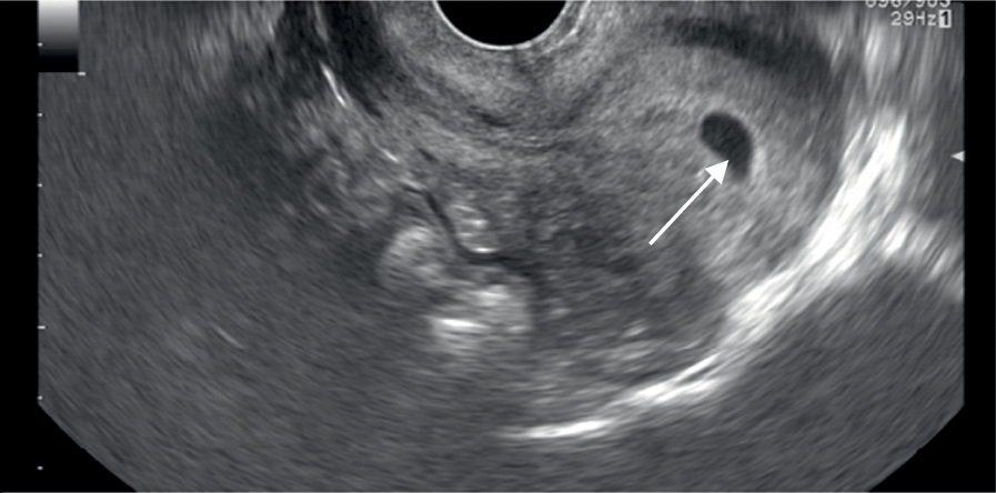 Empty sac tilted uterus ultrasound Retroverted/Tilted Uterus
