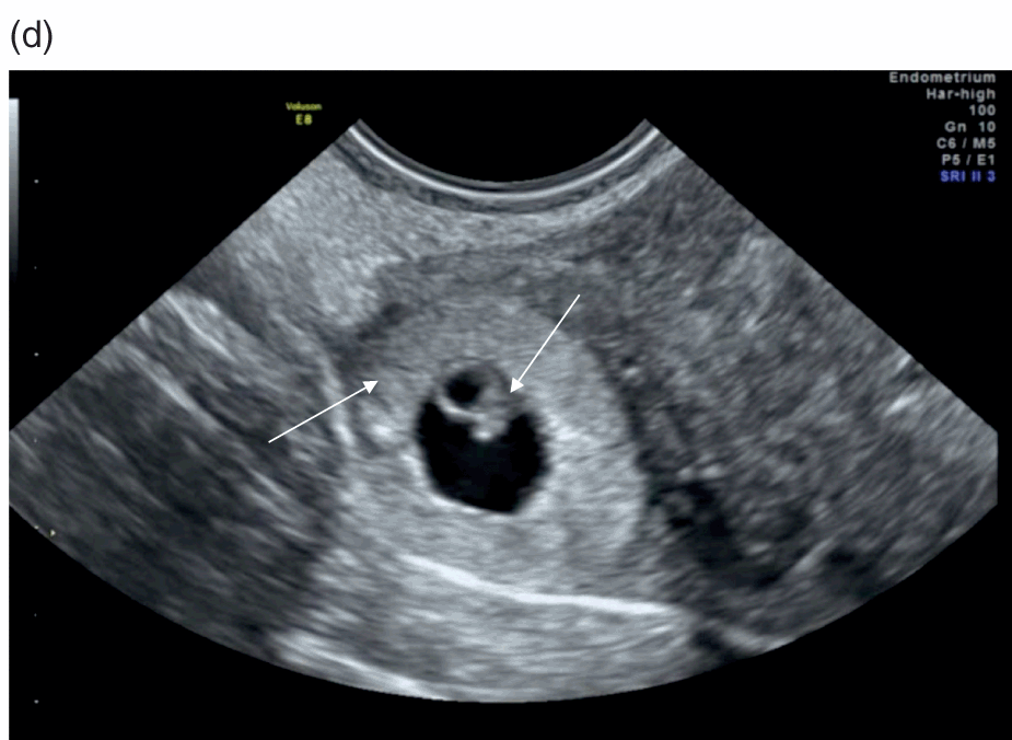 6 ultrasound tilted weeks uterus Tilted uterus
