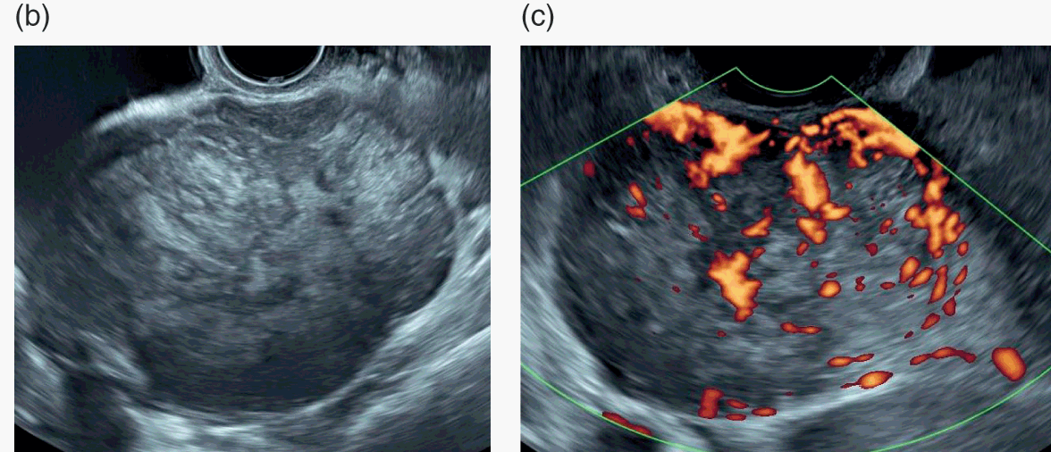 Doppler Ultrasound In Gynaecology Chapter 16 Gynaecological Ultrasound Scanning