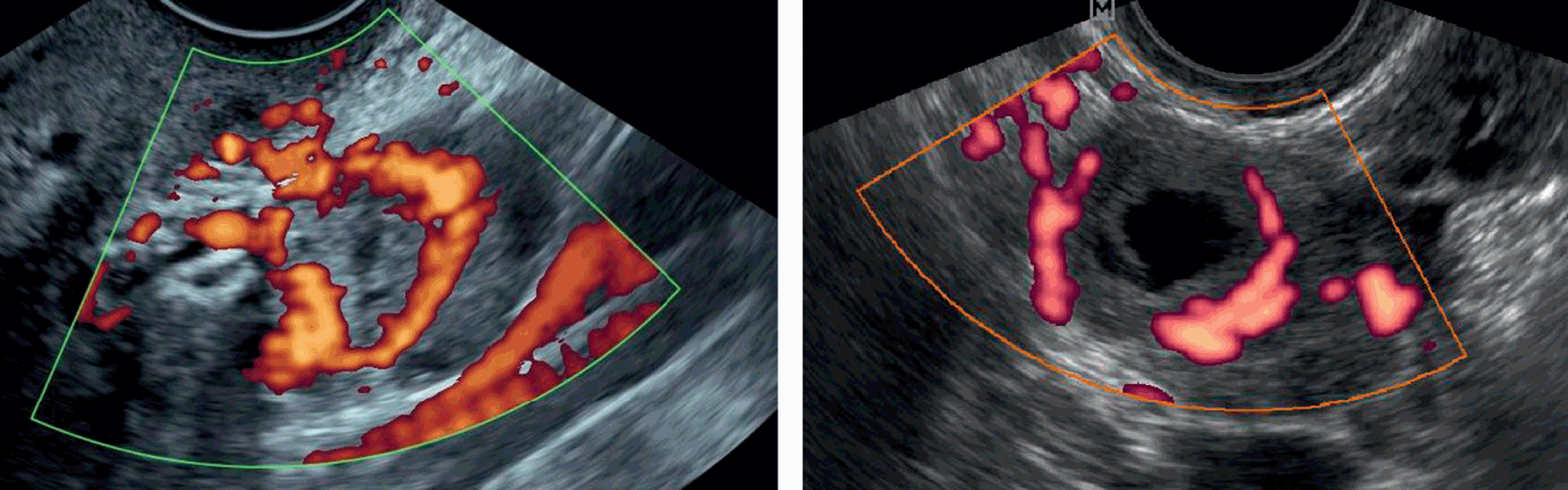 Ultrasound showing large uterine fibroid with ring of fire around |  Download Scientific Diagram