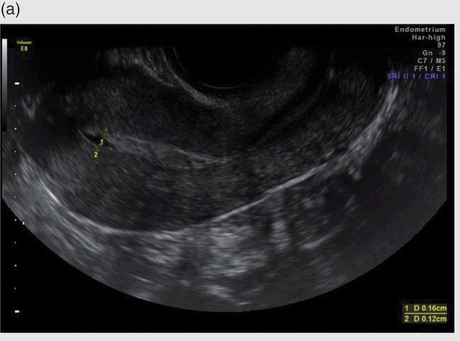 Baseline Sonographic Assessment Of The Female Pelvis Chapter 2 Gynaecological Ultrasound Scanning