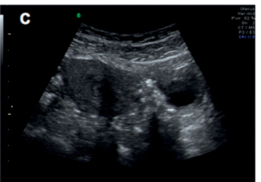 Baseline Sonographic Assessment Of The Female Pelvis Chapter 2 Gynaecological Ultrasound Scanning