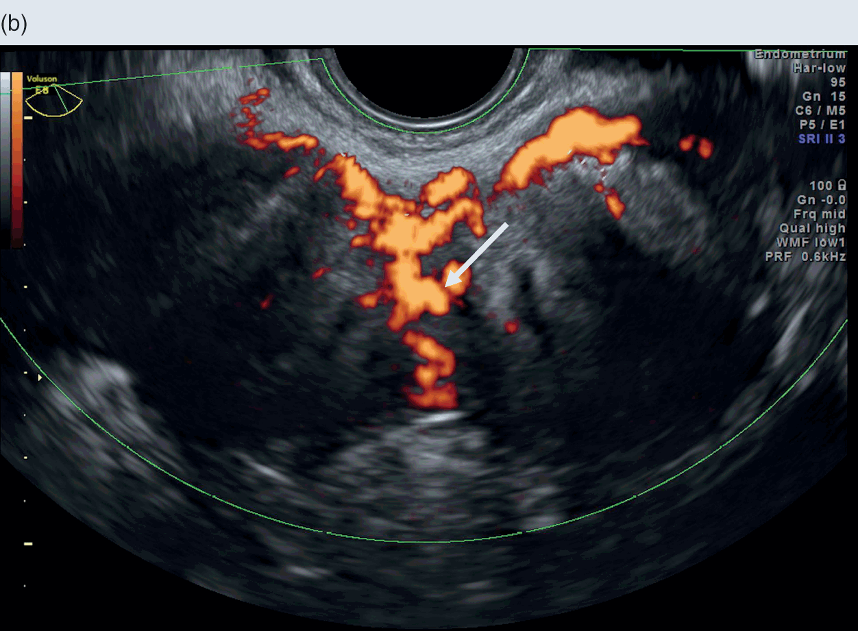 Difficult Gynaecological Ultrasound Examination (Chapter 3) -  Gynaecological Ultrasound Scanning