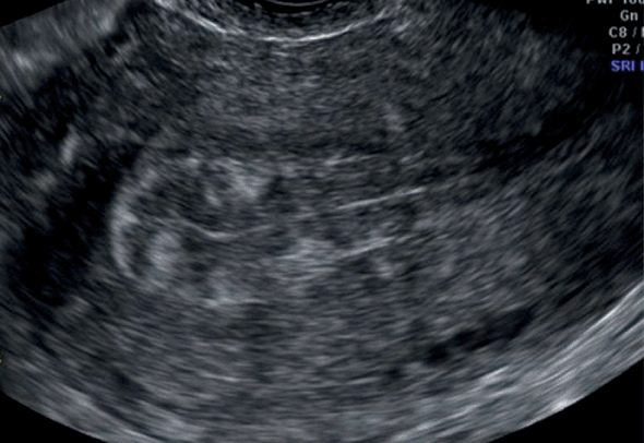 Sonographic Assessment Of Endometrial Pathology Chapter 6 Gynaecological Ultrasound Scanning