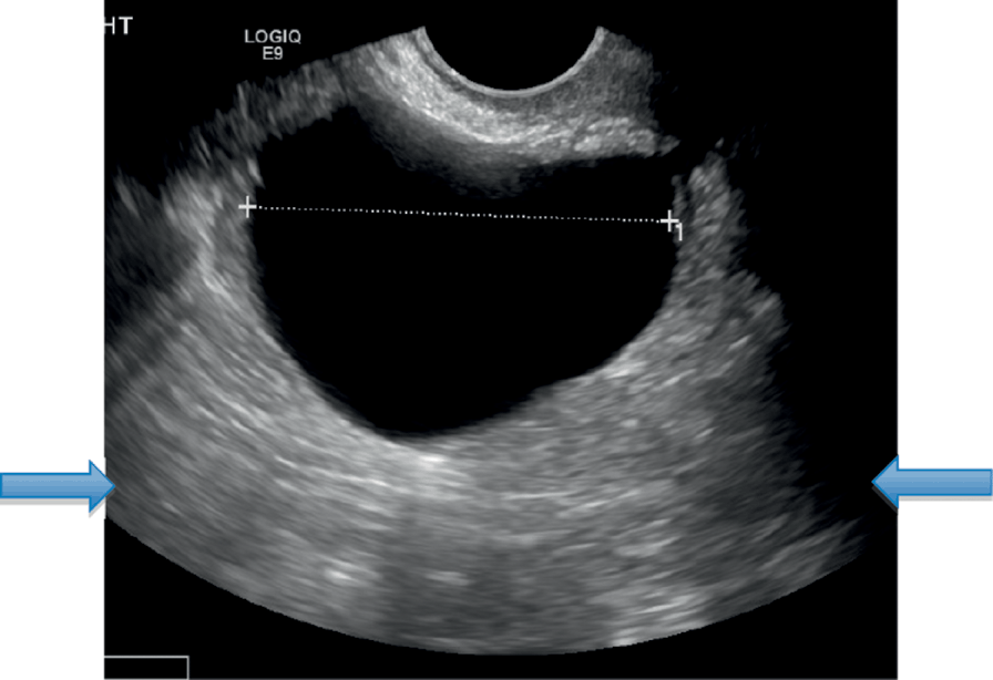 Uterus Cancer Ultrasound