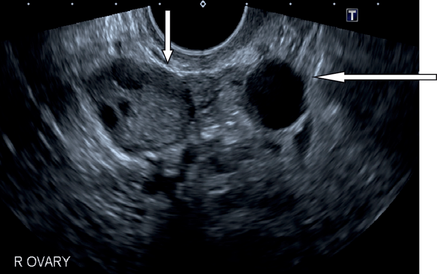 Sonographic Assessment of Ovarian Cysts and Masses (Chapter 8) - Gynaecological Ultrasound Scanning Sonographic Assessment of Ovarian Cysts and Masses (Chapter 8) - Gynaecological Ultrasound Scanning