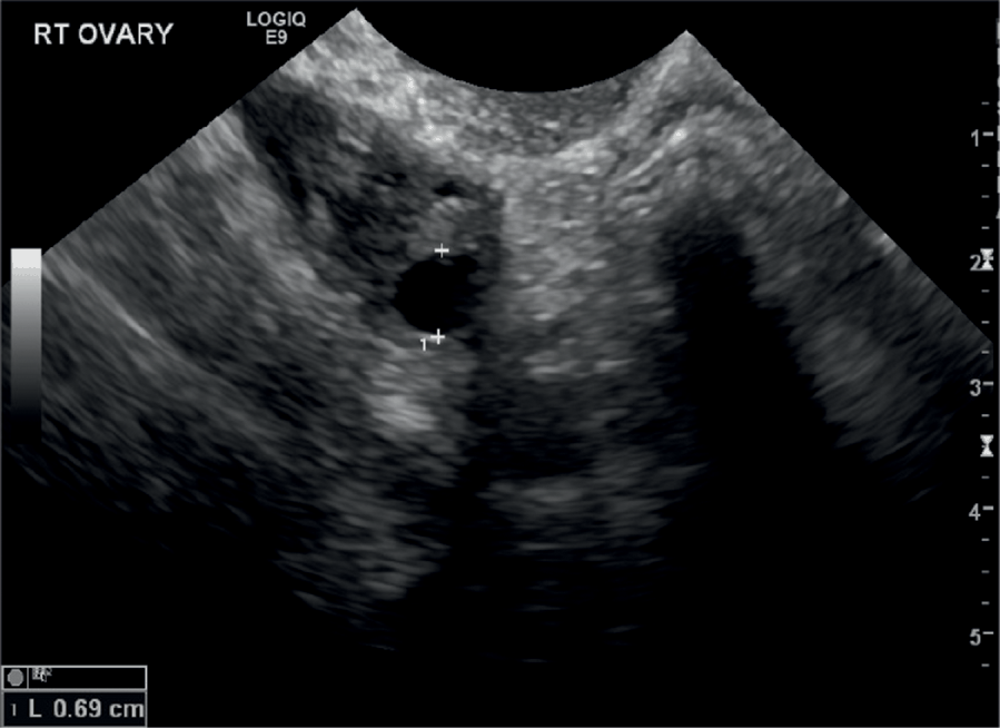 Post Menopausal Simple Ovarian Cysts