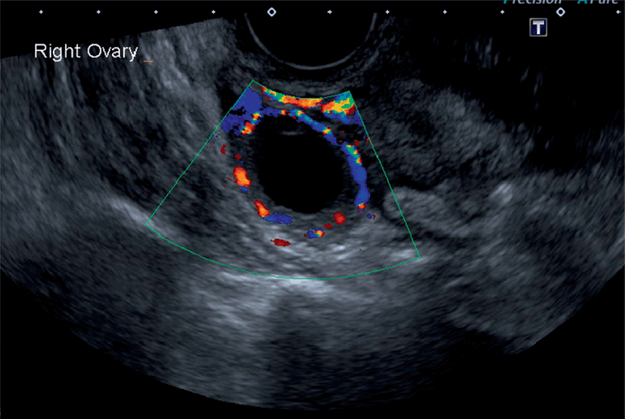 simple ovarian cyst ultrasound