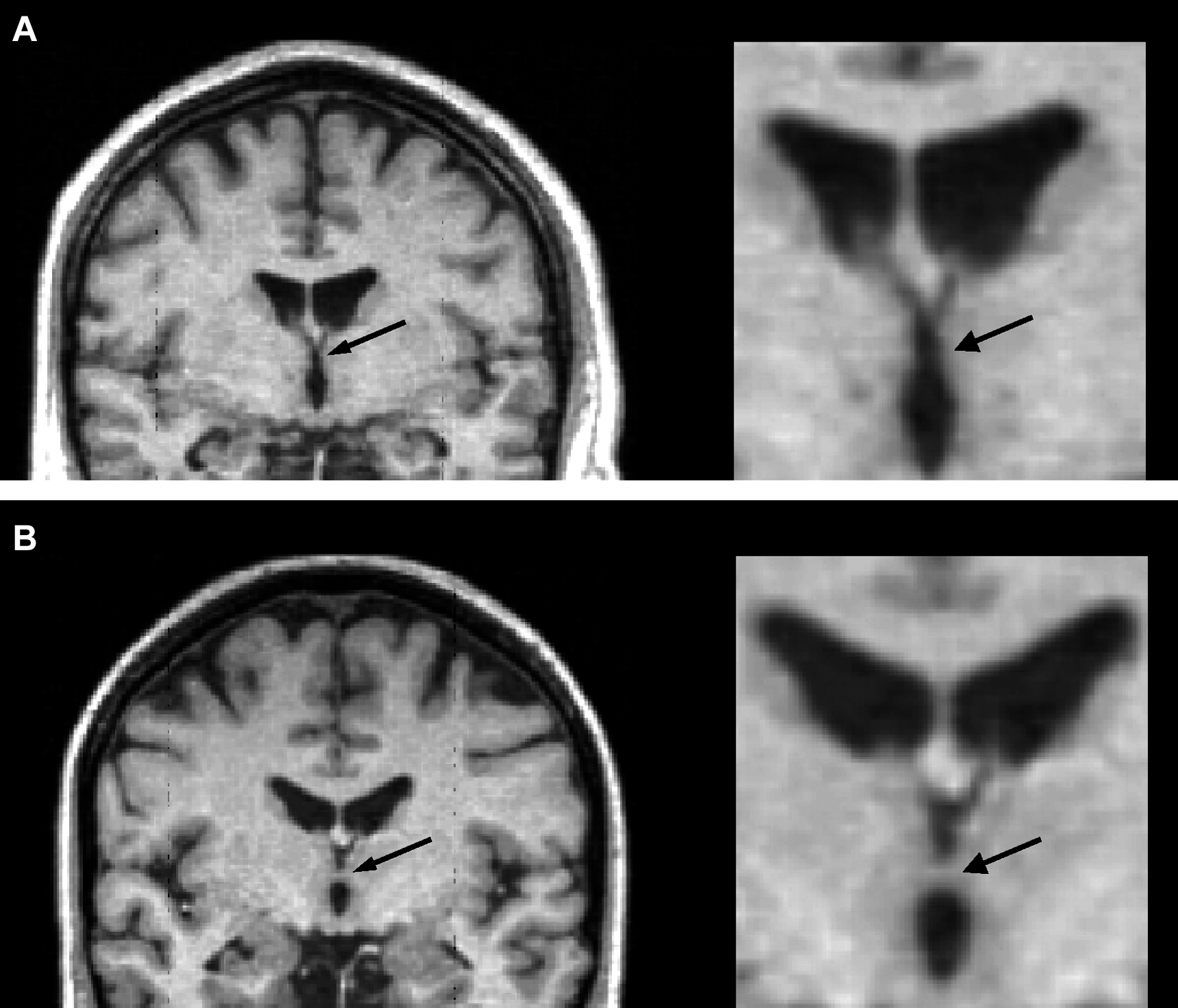 Cavum septum pellucidum and adhesio interthalamica in schizophrenia: an ...