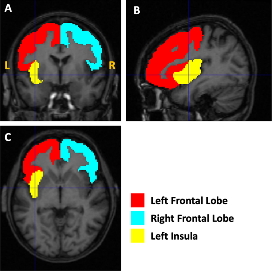 Lower gray matter volumes of frontal lobes and insula in adolescents ...