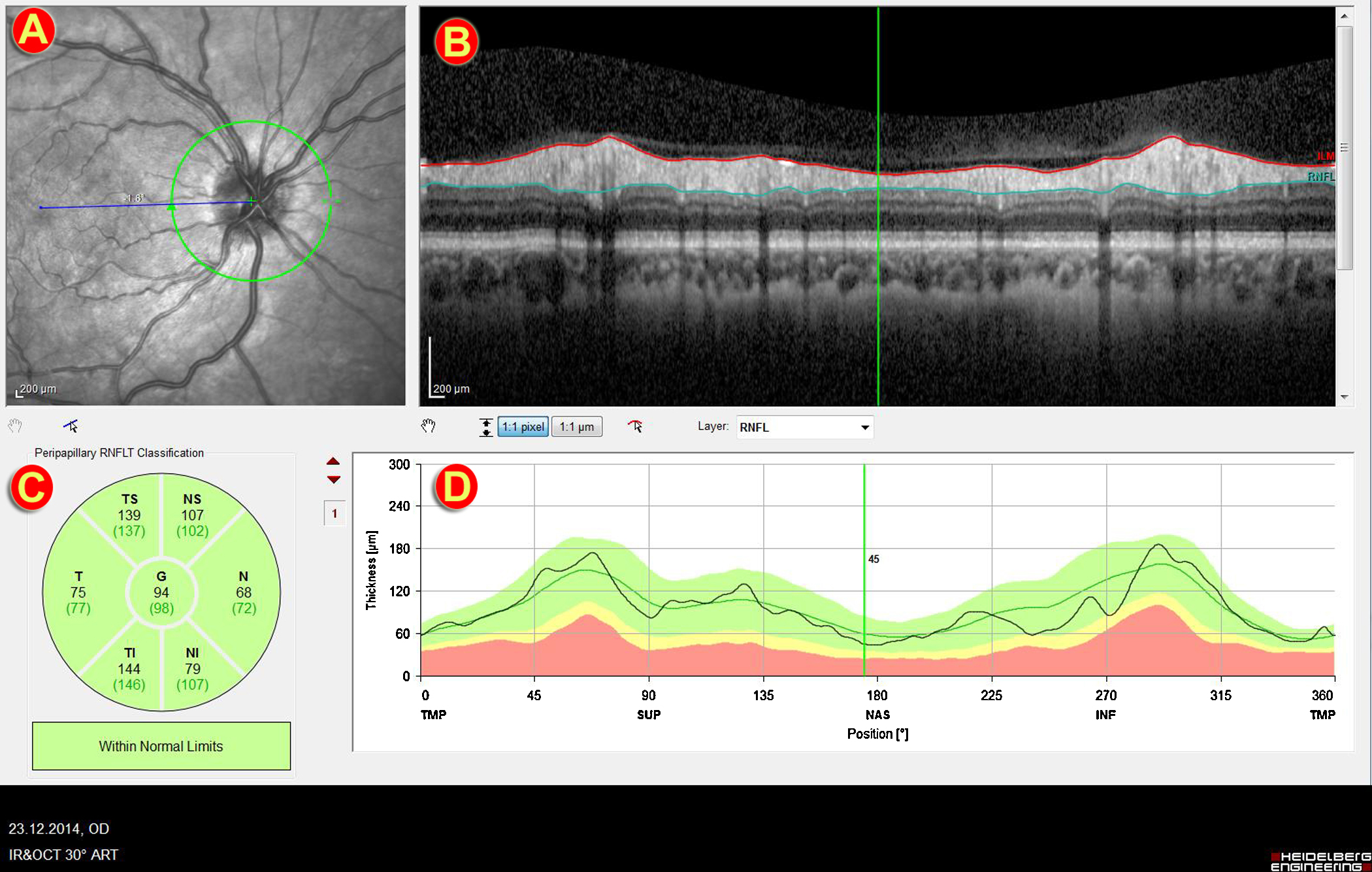 Thickness ( ␮ m) changes of RNFL and GCL = GCL–IPL in relation to