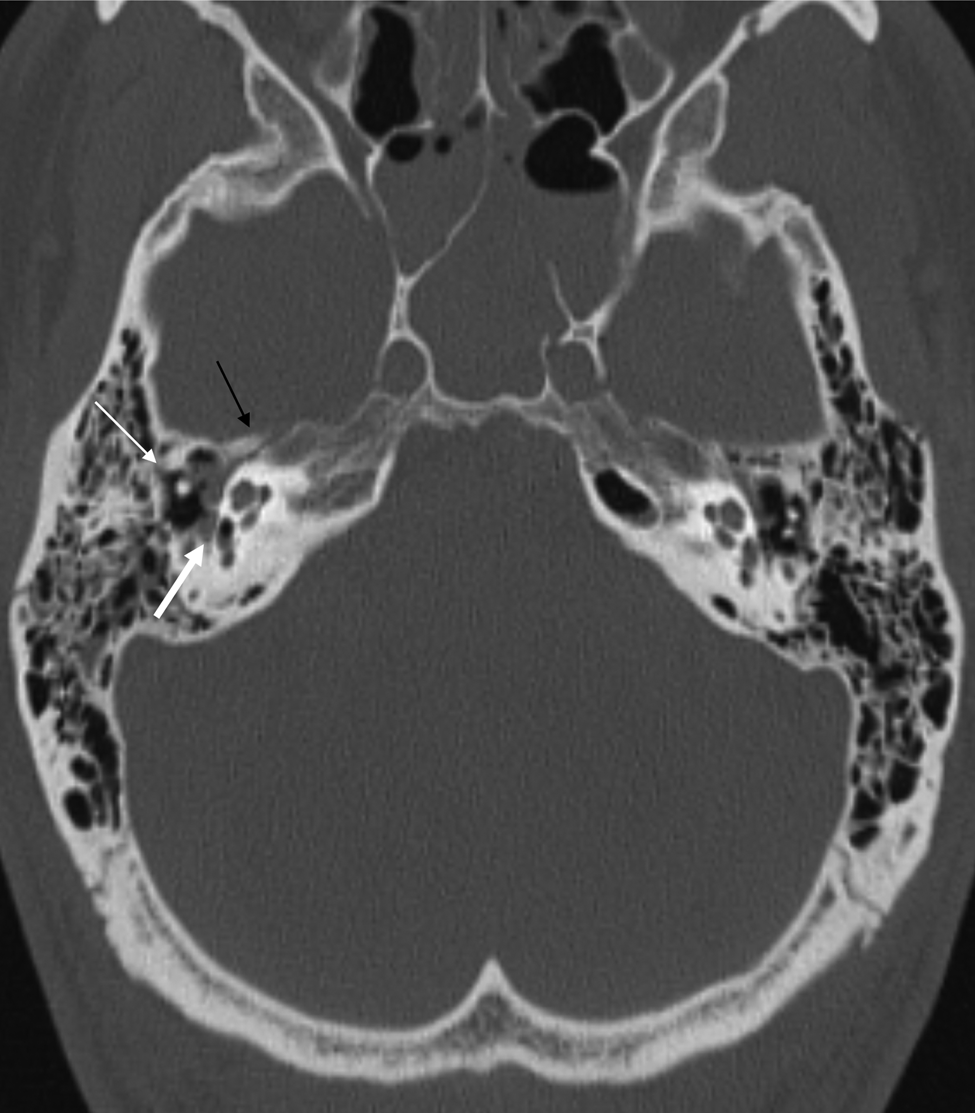 A large case series of temporal bone fractures at a UK major