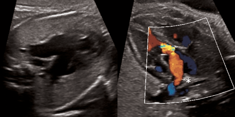 Complete closure of the ductus arteriosus in the foetus with ...