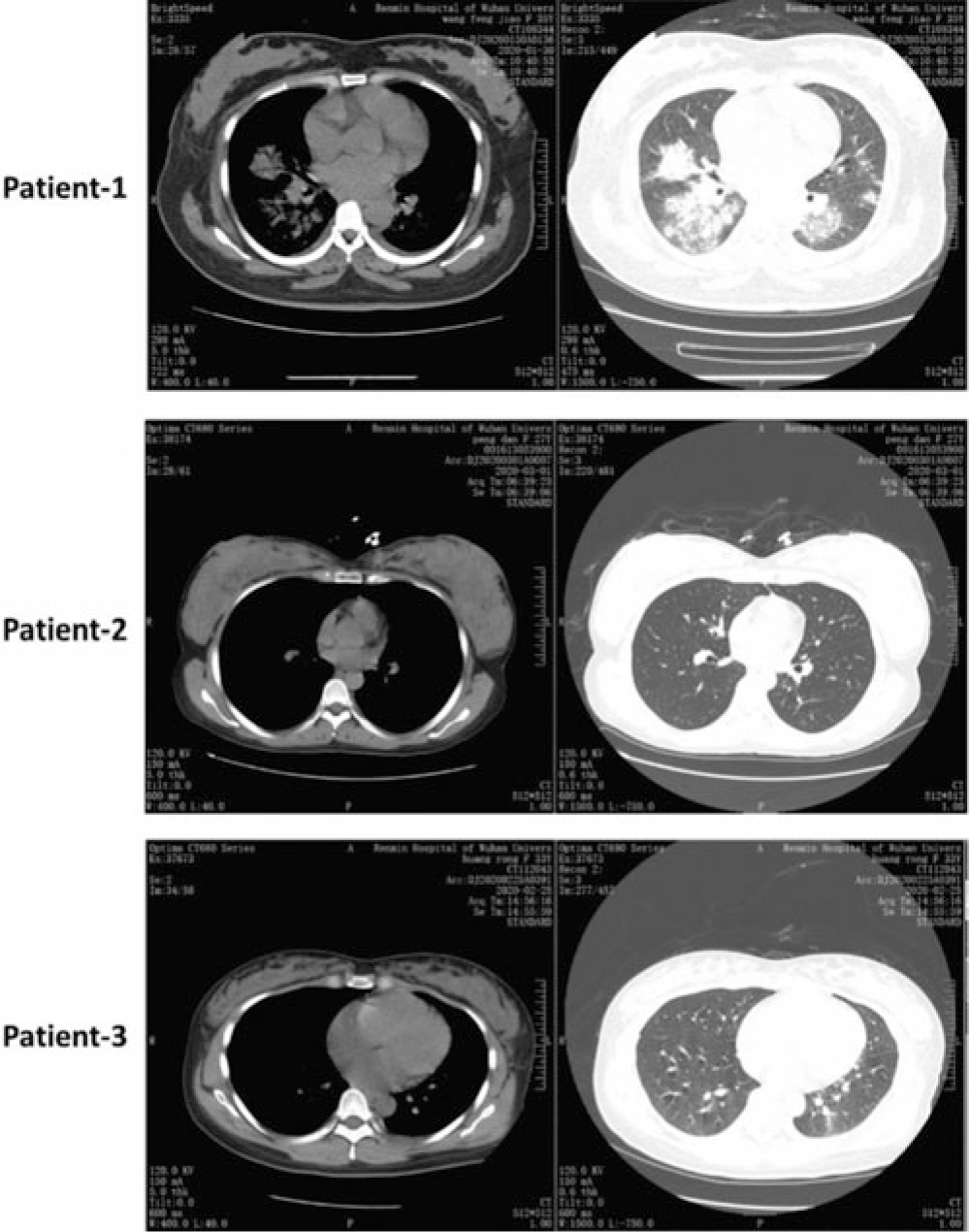 Impact Of COVID-19 Infection On Pregnancy Outcomes And The Risk Of ...