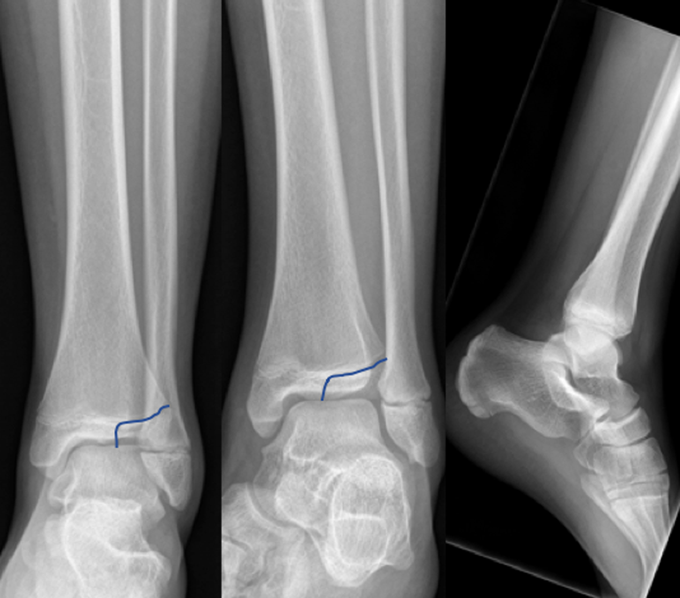 Just The Facts Diagnosing Growth Plate Fractures In The Emergency Department Canadian Journal 2830