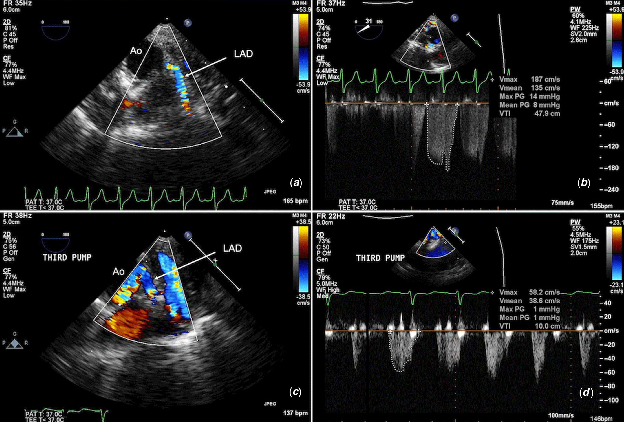 Intraoperative Echocardiographic Coronary Artery Imaging In Congenital ...