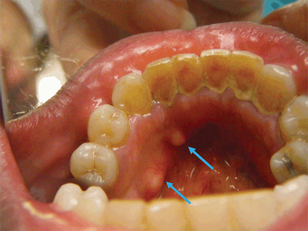 The Oral Cavity Of The Elder Chapter 24 Geriatric Forensic Medicine And Pathology