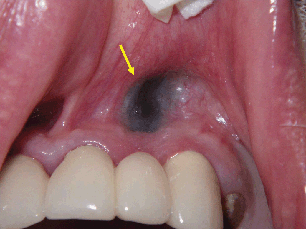 Dental Update - A review of non-plaque-related gingival conditions. Part  Two: Reactive processes, potentially dysplastic and malignant neoplasms,  and pigmented conditions