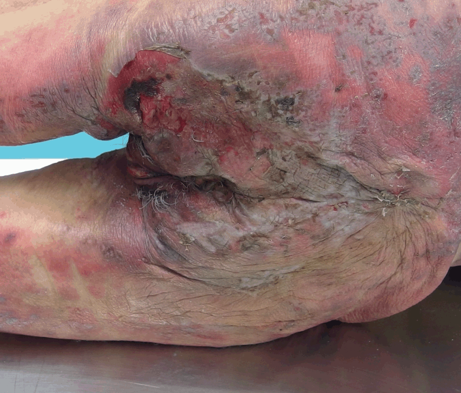 Abdominal wall skin lesions in adult morbid obese women