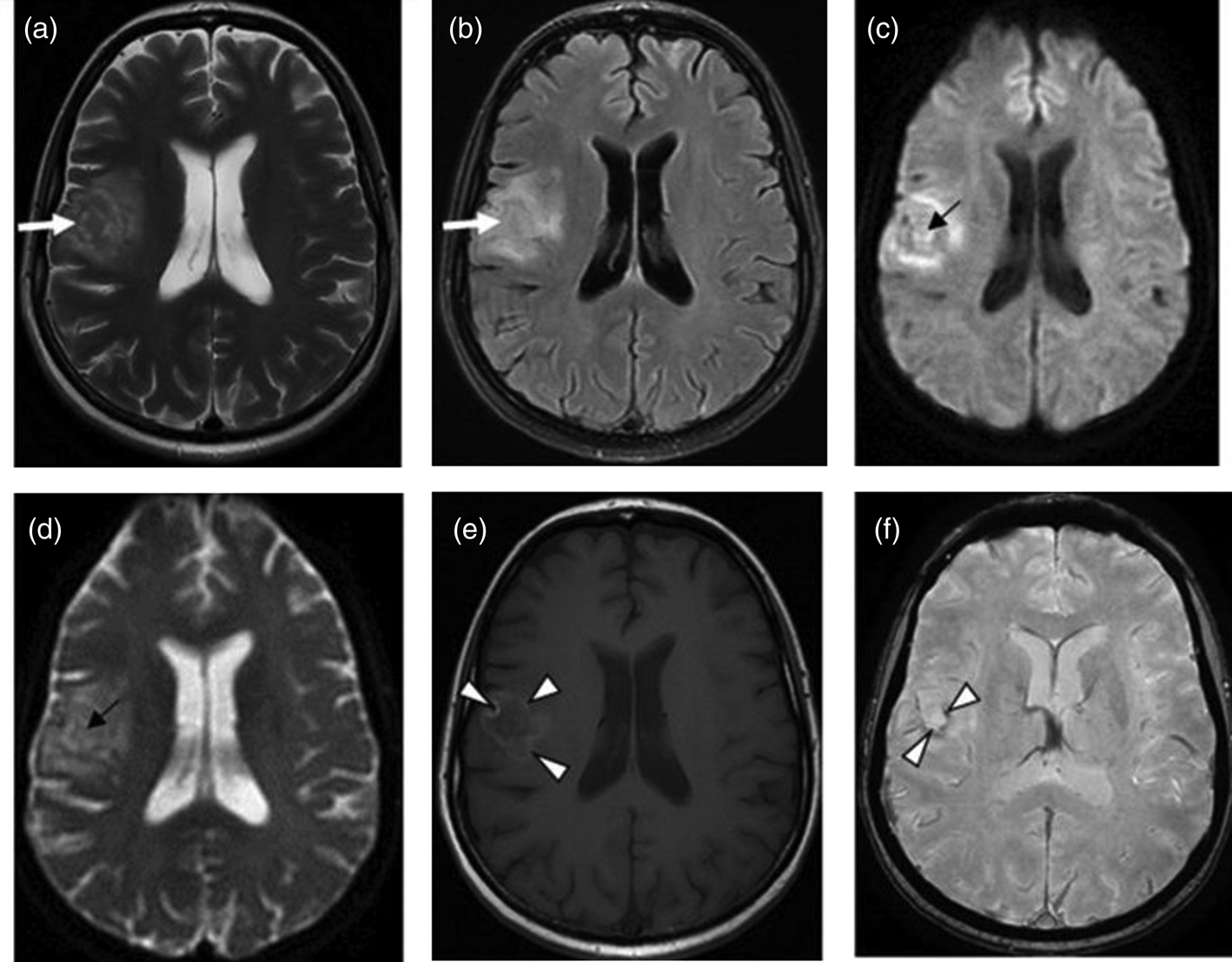 Cerebral toxoplasmosis in HIV-infected patients over 2015–2018 (a case ...