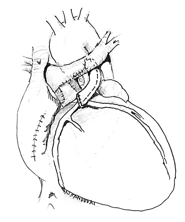 Staged repair of transposition of the great arteries with anomalous ...