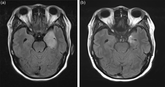 AMPA-R Limbic Encephalitis Associated with Systemic Lupus Erythematosus ...