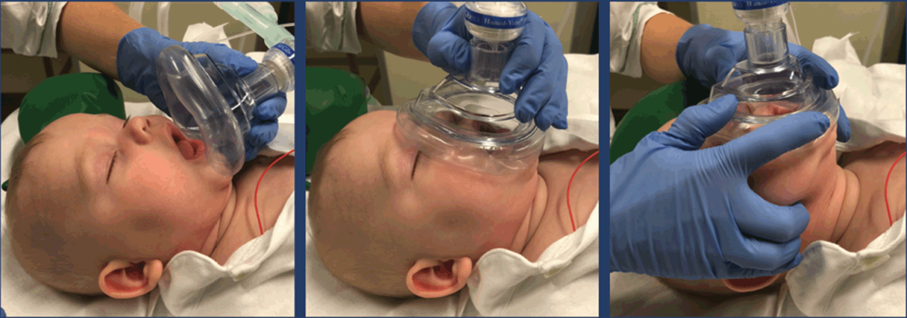 Manual Resuscitator - Infant Mask - Canadian Safety Supplies