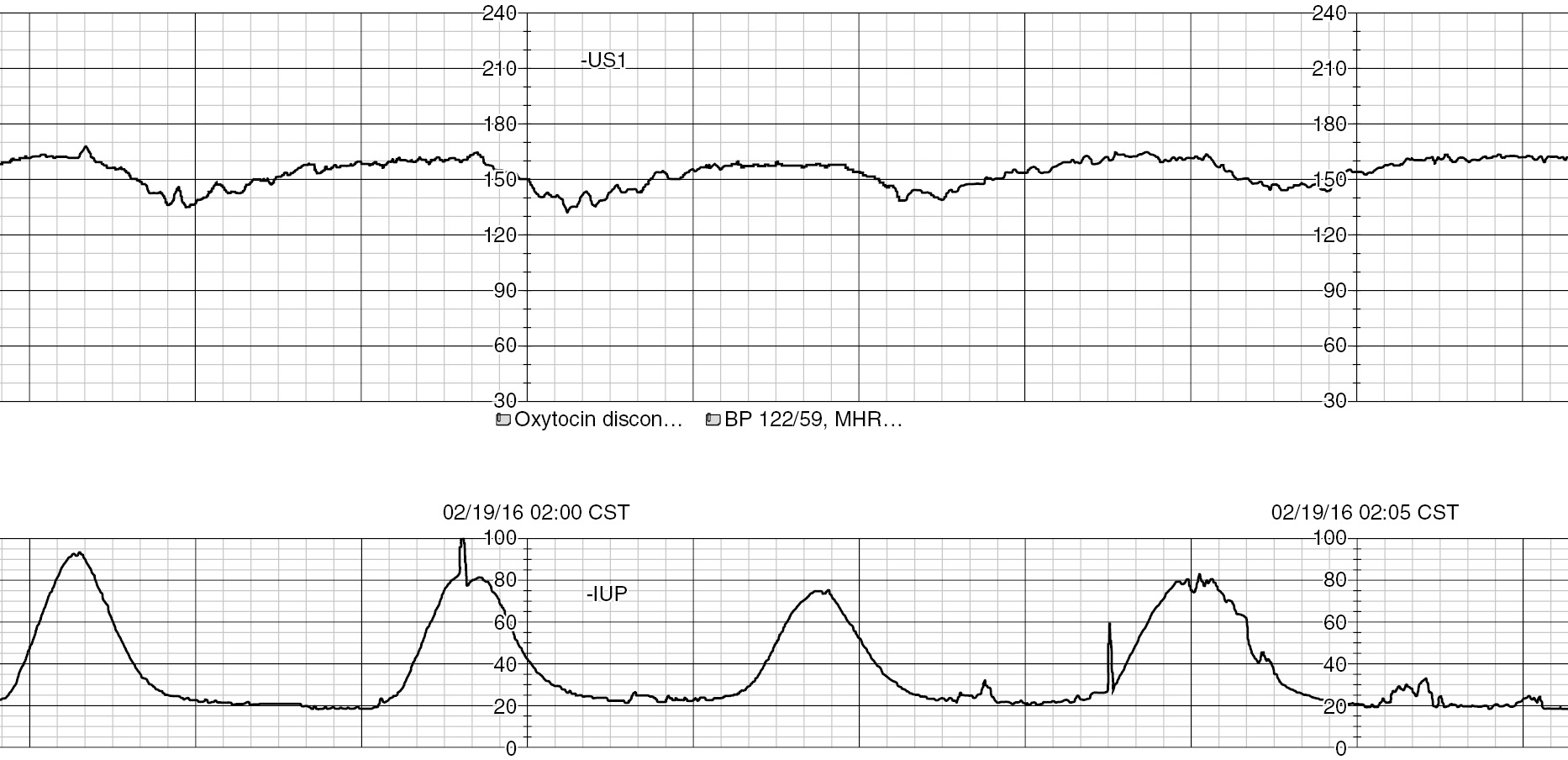 Late Decelerations late-decelerations
