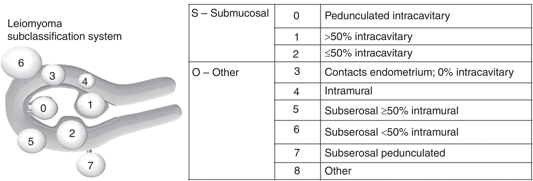 Fibroids and Reproduction (Chapter 6) - Modern Management of Uterine  Fibroids, image size:1870x636