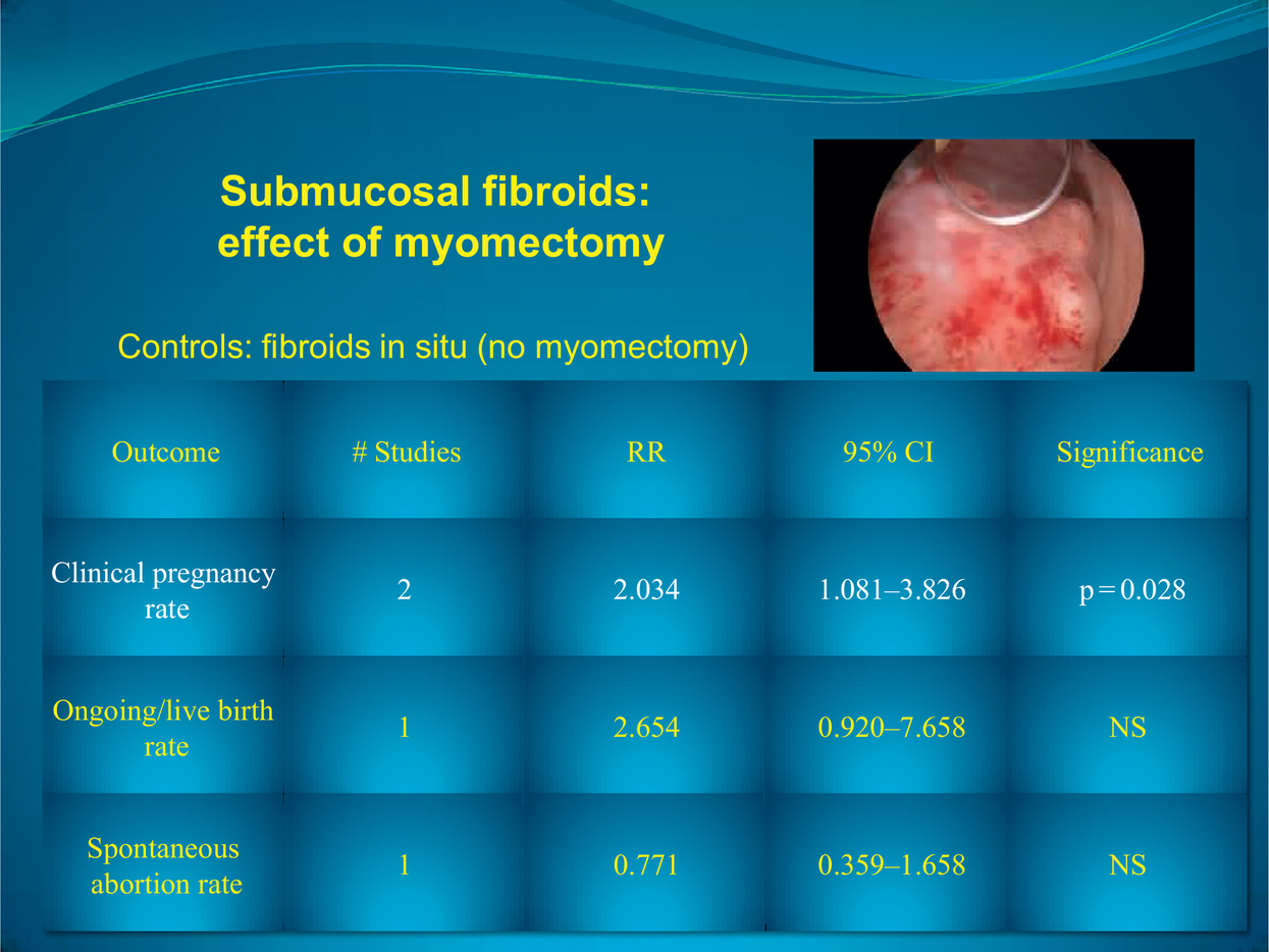 Diagnosis And Management Of Uterine Fibroids: Current, 49% OFF